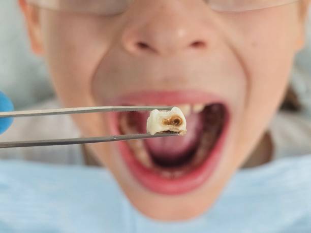 Best Lost Filling or Crown Replacement in Grenelefe, FL
