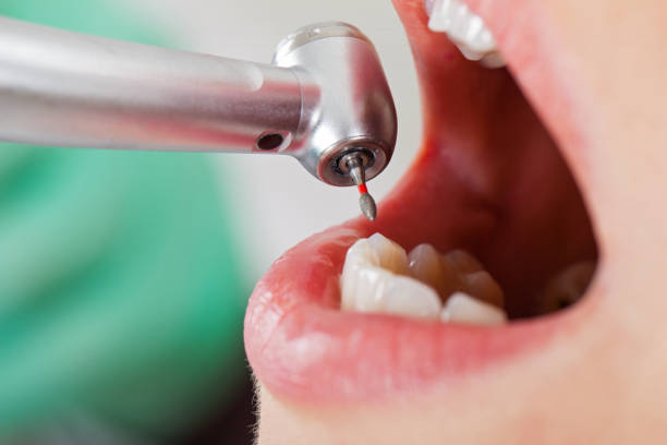 Best Emergency Wisdom Tooth Extraction in Grenelefe, FL